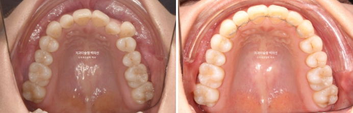옥니 덧니 과개교합 반대교합 중심선 인비절라인 치료기간 1년 관련 이미지 16