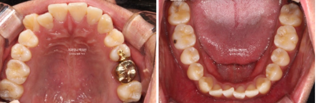 반대교합 비발치 교정 클리피씨 후기 관련 이미지 4