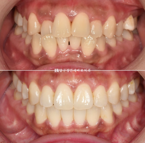 Invisalign Success Depends on Wearing Them Consistently|9-Month Real Treatment Case of Crowding & Underbite image 1