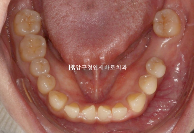 벌어진 치아 교정 인비절라인 라이트 무삭제 라미네이트 치료 관련 이미지 6