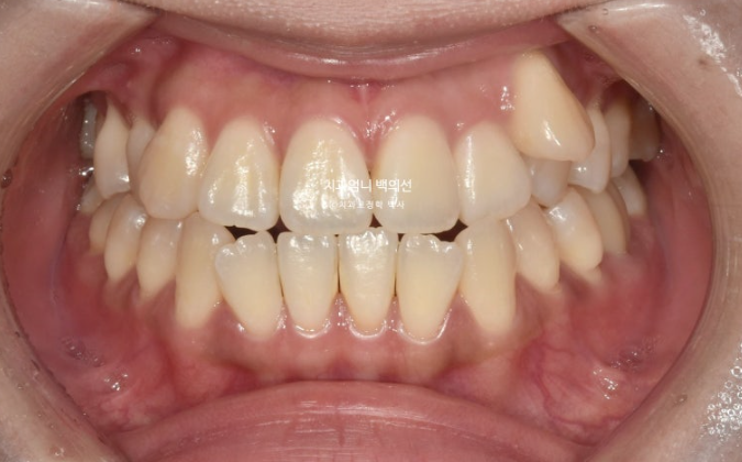 비발치 교정 덧니 인비절라인 교정 절단교합 반대교합 치료기간 1년 6개월 관련 이미지 2
