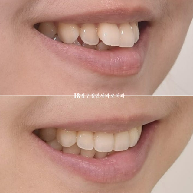 Orthodontic Treatment for International Students: Is Short-Term Treatment Possible in Korea? | A Real 5-Month Front Teeth Partial Orthodontic Case image 11