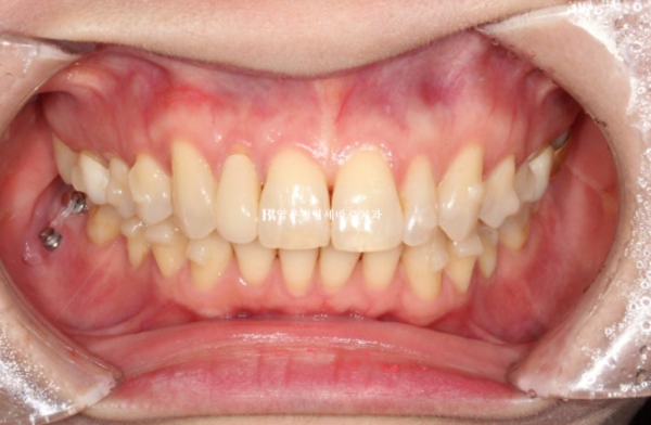 40대 인비절라인 라이트 가위교합? 관련 이미지 9