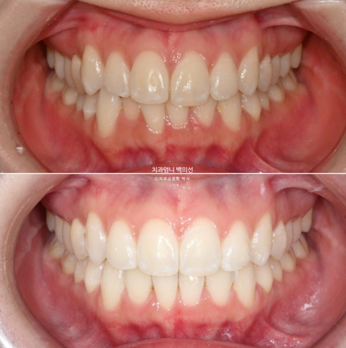 인비절라인 라이트 교정 앞니돌출 과개교합 덧니 교정 관련 이미지 1