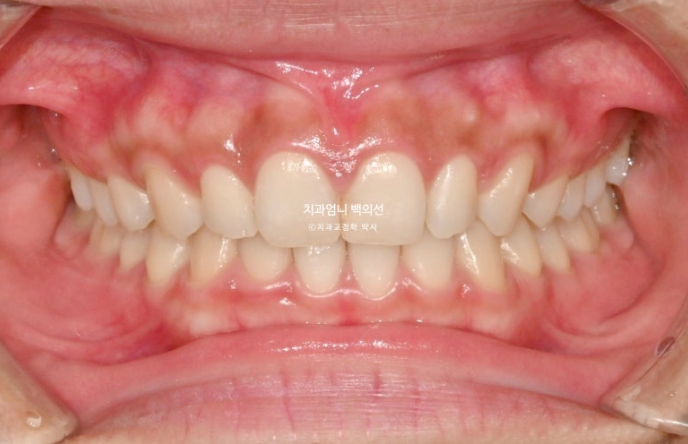 과개교합 옥니 거미스마일 교정 인비절라인 라이트 잇몸성형 후기 관련 이미지 12