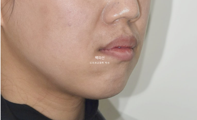 거미스마일 교정 돌출입 발치교정 입술부전 호두턱 치료기간 2년반 관련 이미지 7