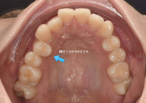 9-Month Invisalign Lite Review|Real Case Improving a Crossbite and Crooked Teeth Together image 3