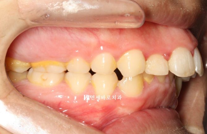 인비절라인 비추천 하는 경우? 관련 이미지 2