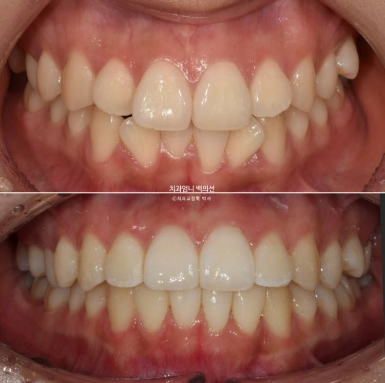 앞니 부분 교정 급속 교정 토끼이빨 MTA 미니튜브 치간삭제 치료기간 9개월 관련 이미지 13