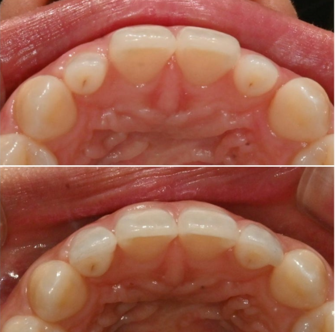왜소치 반점치 (반상치)가 있는 경우 무삭제 라미네이트 치료 관련 이미지 8