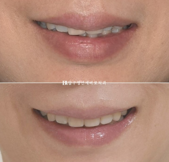 40대 치아교정 가능할까요? 치주염 있어도 치아교정 가능할까요? 임플란트 없이 교정하기 관련 이미지 13
