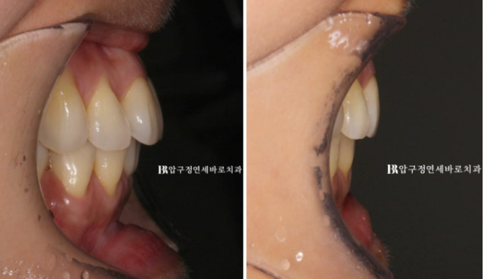 재교정 고민 중이라면 꼭 보세요! 4개월 만에 달라진 앞니 관련 이미지 8