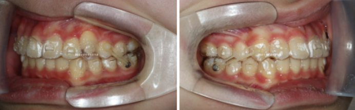 덧니 인비절라인 교정 :: 강남 인비절라인 교정치과 관련 이미지 4