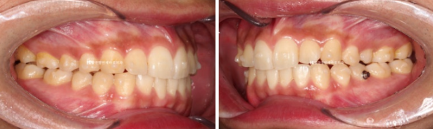 인비절라인 라이트 교정 덧니 이소맹출 반대교합 관련 이미지 7
