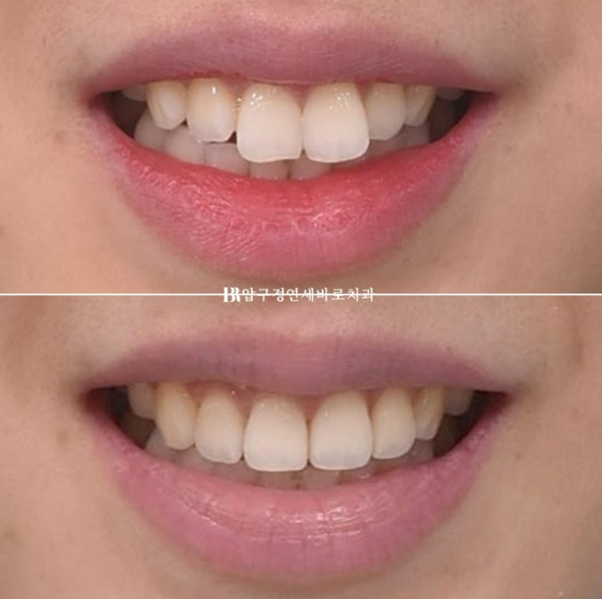 Can Rabbit Teeth Be Corrected? 5-Month Real Case of Butterfly Teeth Anterior Partial Orthodontic Treatment image 11