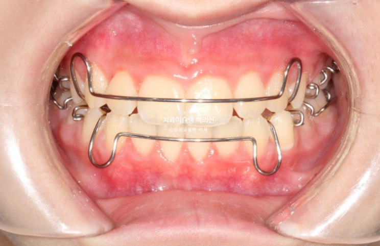 어린이 무턱 성장교정 덧니 인비절라인 퍼스트 악궁확장 치료기간 2년 관련 이미지 26