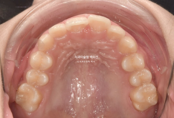 과개교합 인비절라인 모더레이트 컴프레헨시브 중심선 토끼이빨 관련 이미지 4