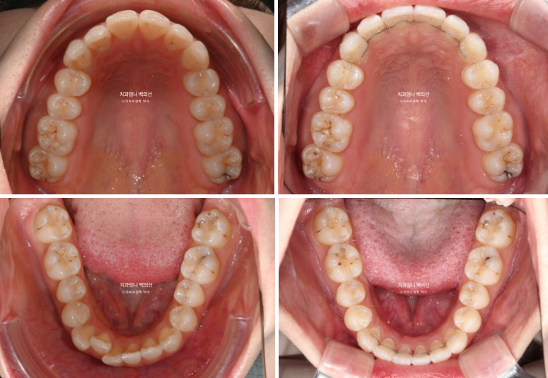 인비절라인 라이트 교정 앞니돌출 과개교합 덧니 교정 관련 이미지 10