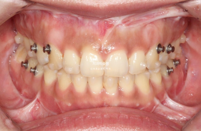 선수술 양악수술 비대칭 주걱턱 잇몸미소 치료 인비절라인 라이트 관련 이미지 7
