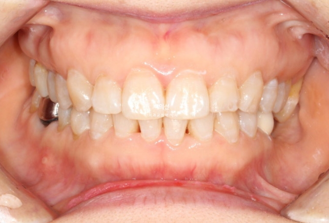 40대 인비절라인 라이트 앞니 돌출 과개교합 덧니 교정 후기 관련 이미지 12