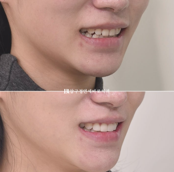 Four No-Prep Veneers for Dwarf Teeth and Conical Front Teeth image 10