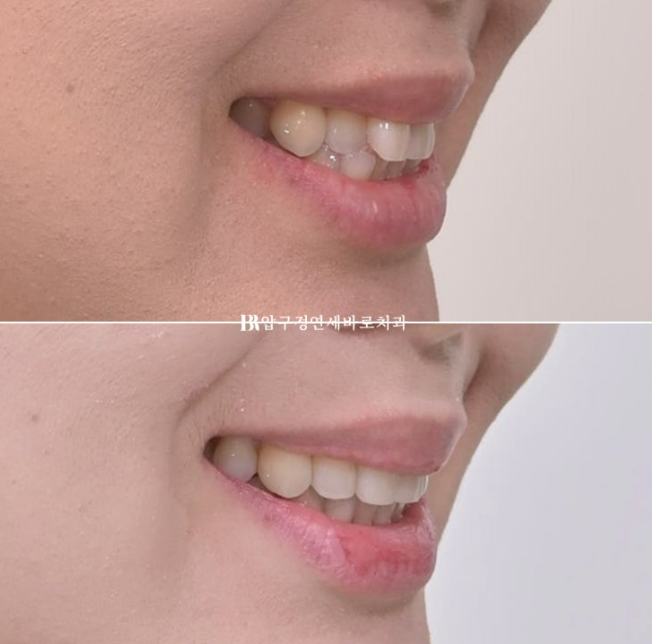 Invisalign Lite Treatment for Crossbite, Rabbit Teeth, and Protruding Front Teeth Correction image 12