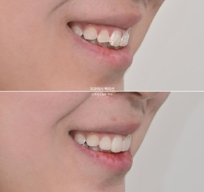 반점치 반상치 치아 하얀 얼룩 치료하기 관련 이미지 9