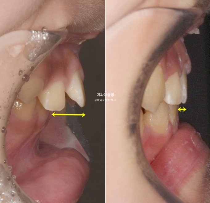 선천적 결손 잔존유치 과개교합 돌출입 인비절라인 퍼스트 어린이 투명교정 치료기간 관련 이미지 22