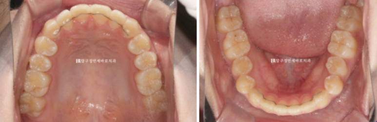 덧니교정 앞니부분교정 치간삭제 후기 관련 이미지 7