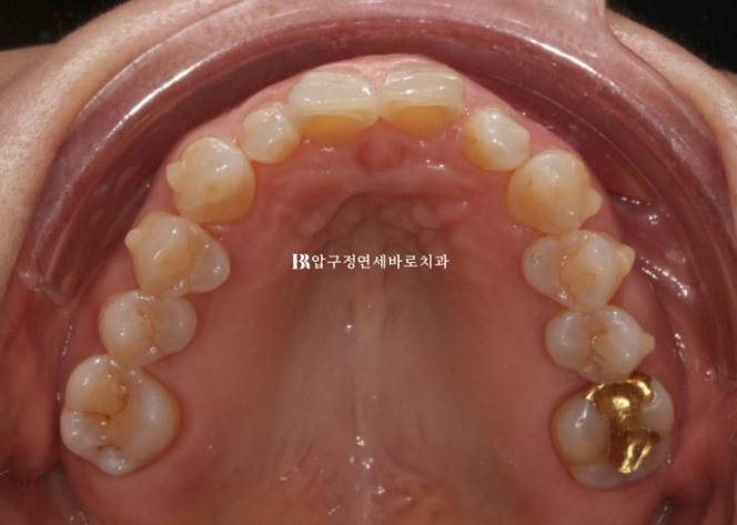 Can It Be Done in Your 50s? Real Results from Limited Front Teeth Orthodontics + No-Prep Laminate Veneers Revealed image 7