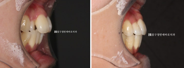 예비신부 교정 단기 앞니 부분교정 치료기간 6개월 관련 이미지 12