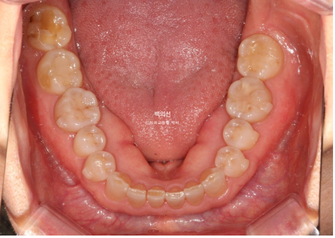 50대 치아교정 :: 인비절라인 익스프레스 치아 벌어짐 단기교정 후기 관련 이미지 12