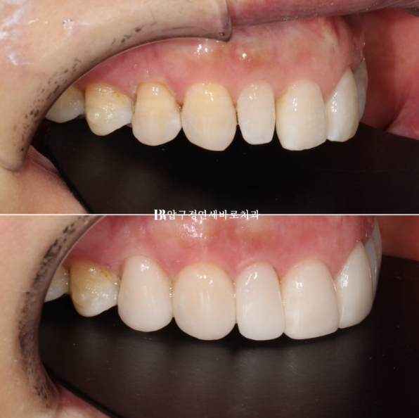 50s Invisalign Lite No-Prep Laminate Bunny Teeth image 13