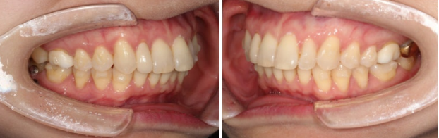 Can Invisalign Lite Work for Patients in Their 40s? A Real Case Improving Scissor Bite and Deep Bite in 10 Months image 11