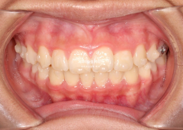 덧니 반대교합 과개교합 인비절라인 퍼스트 악궁확장 어린이 교정 관련 이미지 12