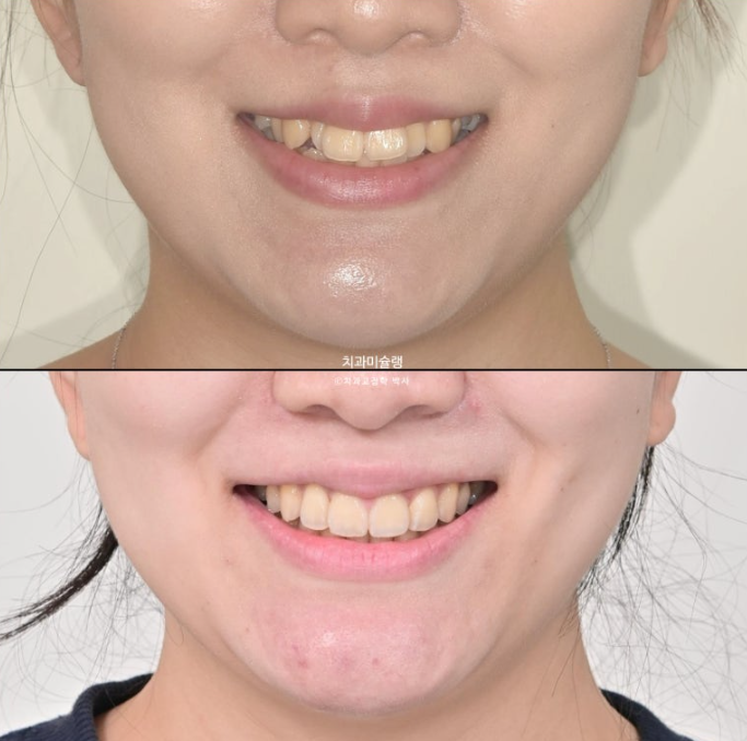 30대 인비절라인 덧니 발치교정 개방교합 치료 관련 이미지 1