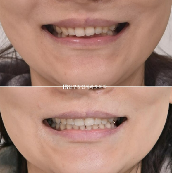 임플란트가 있어도 교정이 가능할까요? 캔팅 재교정 실제 사례 관련 이미지 1