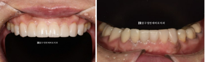 50대 라미네이트 삭제 없이 하는 법? 관련 이미지 8