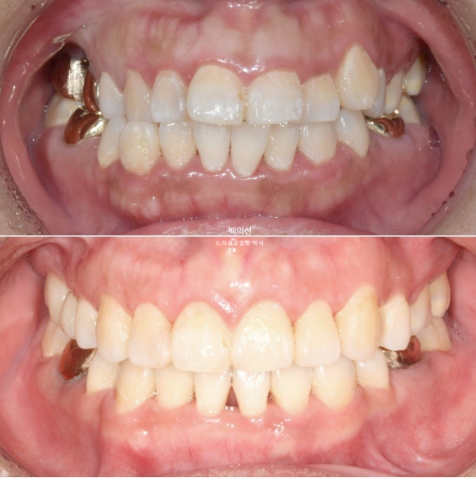 거미스마일 교정 돌출입 발치교정 입술부전 호두턱 치료기간 2년반 관련 이미지 20