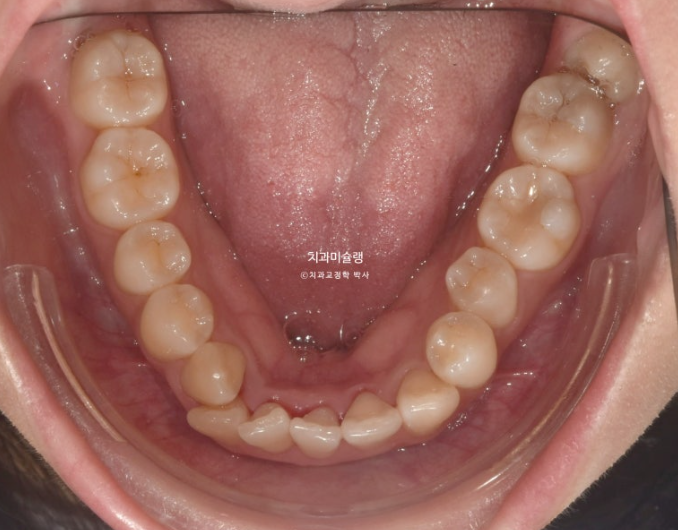 인비절라인 비발치 토끼이빨 교정 덧니 교정 치료기간 1년 8개월 관련 이미지 5