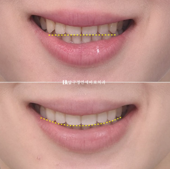 Before and After Non-Prep Veneers: Improving Gaps Between the Front Teeth and the Smile Line Together image 13