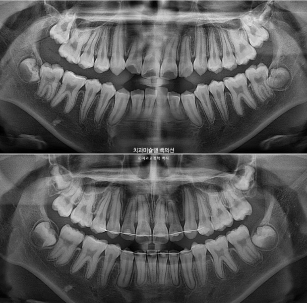 돌출입 무턱 인비절라인 발치교정 덧니 치료기간 1년 11개월 관련 이미지 19