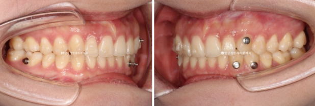 If Inward-Tilted Teeth Make Your Smile Look Constricted? Invisalign Before and After image 7