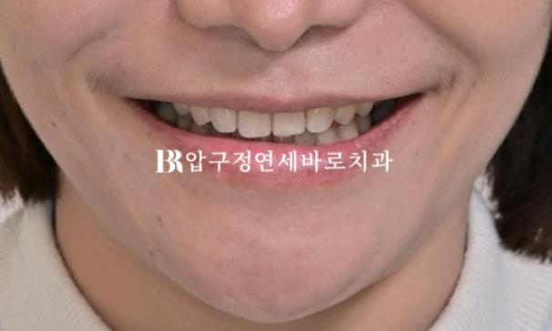 Can Gaps Between the Front Teeth Be Treated with No-Prep Veneers Alone? A Real Case Completed with Gelami After Invisalign Lite image 16
