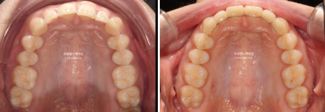 거미스마일 과개교합 교정 잇몸돌출 잇몸 비대칭 관련 이미지 12