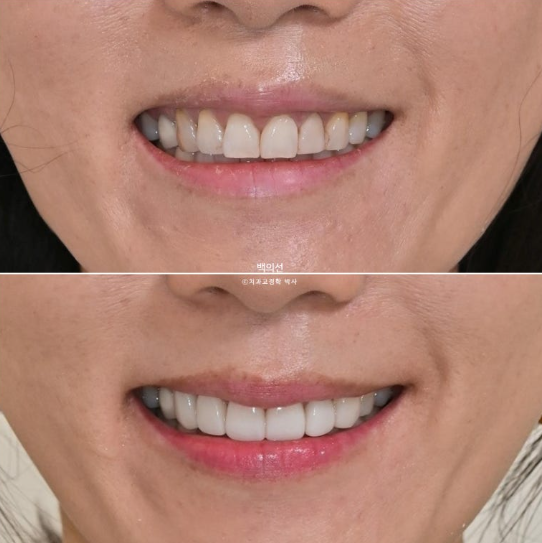 40대 무삭제 라미네이트 블랙트라이앵글 레진 치료 관련 이미지 11
