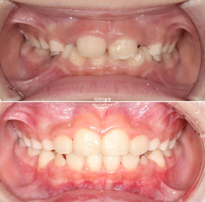 어린이 투명교정 인비절라인 퍼스트 과개교합 교정 후기 관련 이미지 18