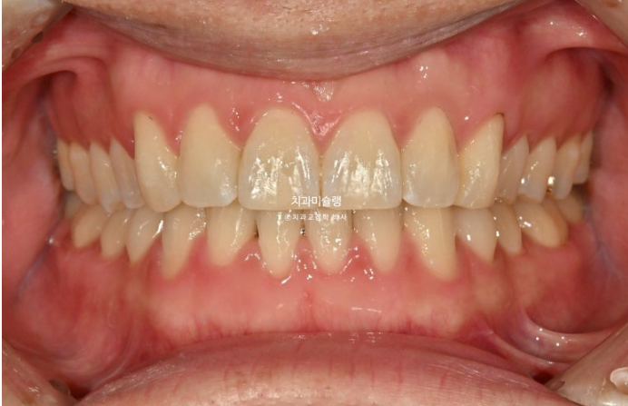 덧니 앞니 부분교정 급속교정 단기 MTA 미니튜브 기간 6개월 관련 이미지 9
