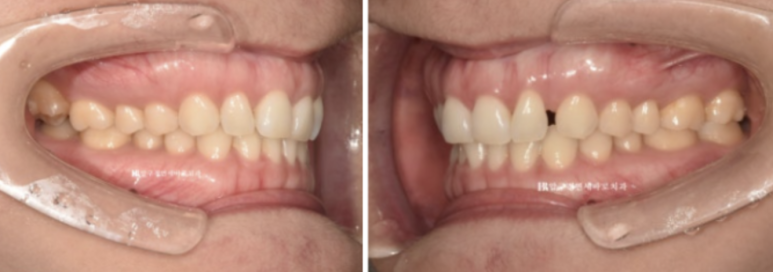 인비절라인 라이트 가위교합 치아 벌어짐 치료 관련 이미지 3