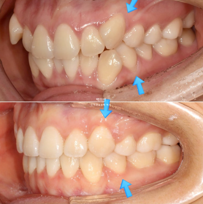 덧니 발치교정 클리피씨 입매 부작용 인중 입술 잇몸 퇴축 관련 이미지 15